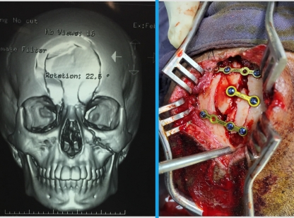 Neurosurgery Hospital in KPHB Kompally Hyderabad